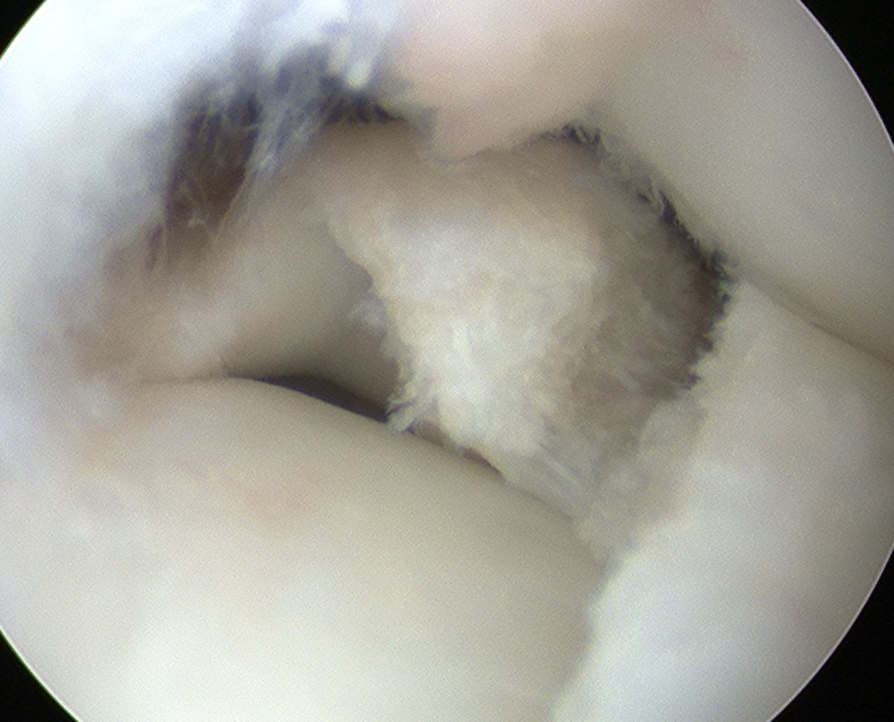 Discoid Meniscus Saucerisation 3